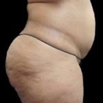 Liposuction and Mommy Makeover Before & After Patient #1177