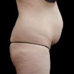 Liposuction and Mommy Makeover Before & After Patient #1186