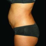 Liposuction and Mommy Makeover Before & After Patient #1193