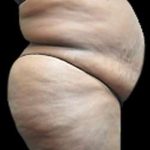 Liposuction and Mommy Makeover Before & After Patient #1231