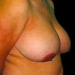 Liposuction and Breast Reduction Before & After Patient #672