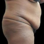 Liposuction and Mommy Makeover Before & After Patient #1240