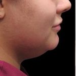 Laser Neck Lift and Submental Liposuction Before & After Patient #1258