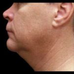Laser Neck Lift and Submental Liposuction Before & After Patient #1272