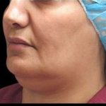 Laser Neck Lift and Submental Liposuction Before & After Patient #1279