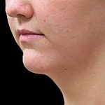 Laser Neck Lift and Submental Liposuction Before & After Patient #1286