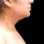 Laser Neck Lift and Submental Liposuction Before & After Patient #1297