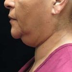 Laser Neck Lift and Submental Liposuction Before & After Patient #1315
