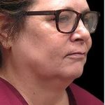Laser Neck Lift and Submental Liposuction Before & After Patient #1328