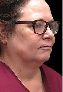 Laser Neck Lift and Submental Liposuction Before & After Patient #1328