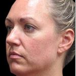 Laser Neck Lift and Submental Liposuction Before & After Patient #1335