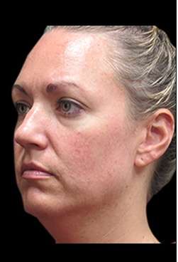 Laser Neck Lift and Submental Liposuction Before & After Patient #1335