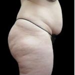 Super Wet Liposuction Before & After Patient #1353