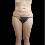 Super Wet Liposuction Before & After Patient #1358