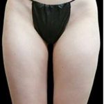 Super Wet Liposuction Before & After Patient #1372