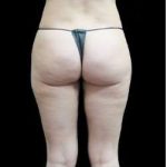 Super Wet Liposuction Before & After Patient #1394