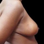Liposuction and Breast Reduction Before & After Patient #639
