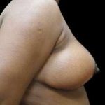 Liposuction and Breast Reduction Before & After Patient #726