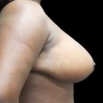 Liposuction and Breast Reduction Before & After Patient #733