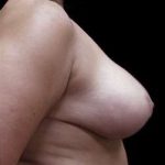 Liposuction and Breast Reduction Before & After Patient #740