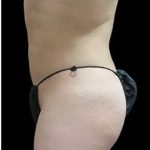 Laser Liposuction and Cellulaze Before & After Patient #759