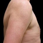 Liposuction and Gynecomastia Before & After Patient #775