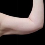 Arm Liposuction Before & After Patient #622
