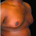 Liposuction and Gynecomastia Before & After Patient #793