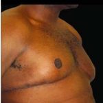Liposuction and Gynecomastia Before & After Patient #800