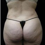 Female Liposuction Before & After Patient #825