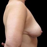 Liposuction and Breast Reduction Before & After Patient #650