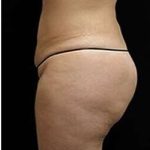 Female Liposuction Before & After Patient #834