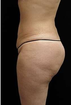 Female Liposuction Before & After Patient #834