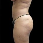 Female Liposuction Before & After Patient #852