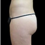 Female Liposuction Before & After Patient #877