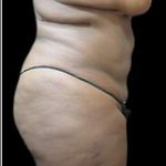 Female Liposuction Before & After Patient #887