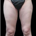Female Liposuction Before & After Patient #894