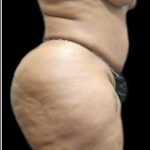 Female Liposuction Before & After Patient #908