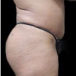 Female Liposuction Before & After Patient #915