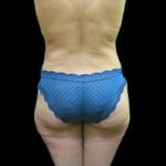 Female Liposuction Before & After Patient #930