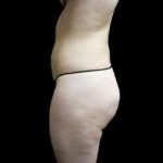 Female Liposuction Before & After Patient #939