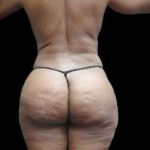 Female Liposuction Before & After Patient #960
