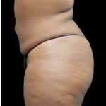 Female Liposuction Before & After Patient #995