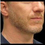 Male Liposuction Before & After Patient #1039
