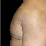 Male Liposuction Before & After Patient #1057