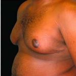 Male Liposuction Before & After Patient #1064