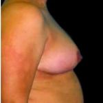 Liposuction and Breast Reduction Before & After Patient #672