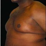 Male Liposuction Before & After Patient #1071