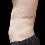 Male Liposuction Before & After Patient #1089