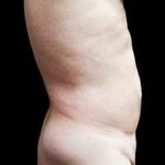 Male Liposuction Before & After Patient #1099